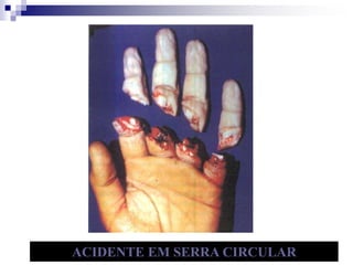 ACIDENTE EM SERRA CIRCULAR 
 