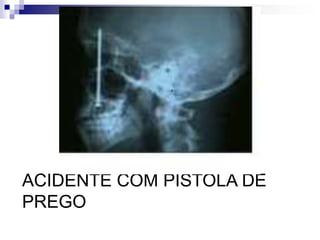 ACIDENTE COM PISTOLA DE 
PREGO 
 