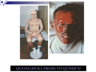 QUEIMADURA PRODUTO QUÍMICO 
 