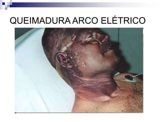QUEIMADURA ARCO ELÉTRICO 
 