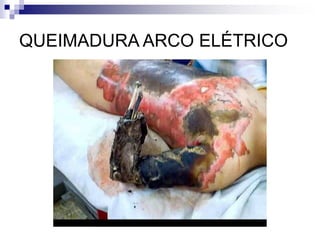 QUEIMADURA ARCO ELÉTRICO 
 
