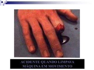 ACIDENTE QUANDO LIMPAVA 
MÁQUINA EM MOVIMENTO 
 