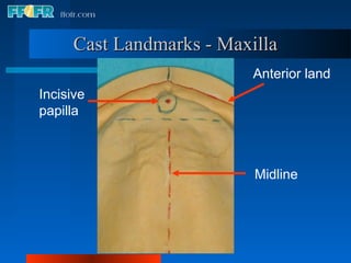 Cast Landmarks - Maxilla
                           Anterior land
Incisive
papilla



                           Midline
 