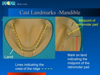 Cast Landmarks -Mandible
                                     Midpoint of
                                   retromolar pad




                              Mark on land
Land
                              indicating the
       Lines indicating the   midpoint of the
       crest of the ridge     retromolar pad
 