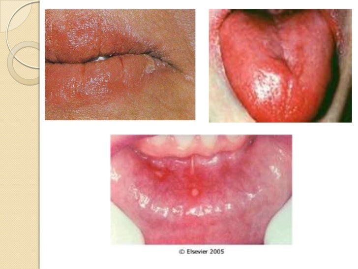 Foods To Avoid With Thrush Foods To Avoid With Thrush