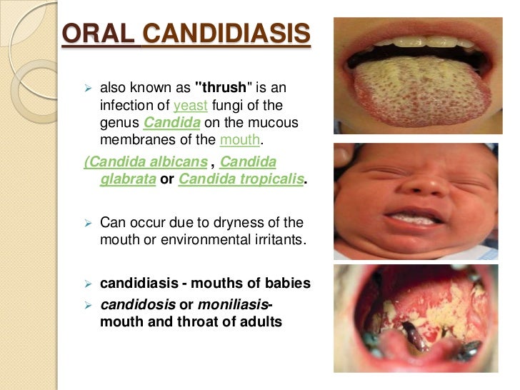 Oral Candidiasis Pictures - Symptoms, Photos, Images and pictures of oral thrush