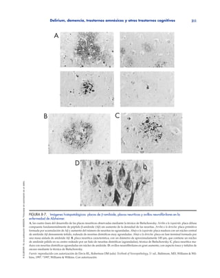Delirium, demencia, trastornos amnésicos y otros trastornos cognitivos 311
©ELSEVIER.EsunapublicaciónMASSON.Fotocopiarsinautorizaciónesundelito.
FIGURA 8-7. Imágenes histopatológicas: placas de β-amiloide, placas neuríticas y ovillos neuroﬁbrilares en la
enfermedad de Alzheimer.
A, las cuatro fases del desarrollo de las placas neuríticas observadas mediante la técnica de Bielschowsky. Arriba a la izquierda: placa difusa
compuesta fundamentalmente de péptido β-amiloide (Aβ) sin aumento de la densidad de las neuritas. Arriba a la derecha: placa primitiva
formada por acumulación de Aβ y aumento del número de neuritas no agrandadas. Abajo a la izquierda: placa madura con un núcleo central
de amiloide Aβ densamente teñido, rodeado de neuritas distróficas muy agrandadas. Abajo a la derecha: placa en fase terminal formada por
una masa aislada de amiloide Aβ. B, placa neurítica característica, con un diámetro de aproximadamente 100 μm, que contiene un núcleo
de amiloide pálido en su centro rodeado por un halo de neuritas distróficas (agrandadas), técnica de Bielschowsky. C, placa neurítica ma-
dura con neuritas distróficas agrandadas sin núcleo de amiloide. D, ovillos neurofibrilares en gran aumento, con aspecto tosco y teñidos de
oscuro mediante la técnica de Bielschowsky.
Fuente: reproducido con autorización de Davis RL, Robertson DM (eds): Textbook of Neuropathology, 3.a
ed., Baltimore, MD, Williams & Wil-
kins, 1997. ©
1997, Williams & Wilkins. Con autorización.
 