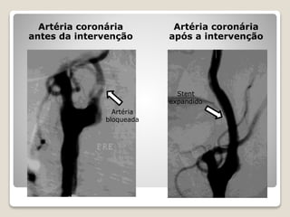 Artéria coronária
antes da intervenção
Artéria coronária
após a intervenção
Artéria
bloqueada
Stent
expandido
 