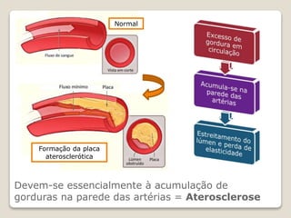 Devem-se essencialmente à acumulação de
gorduras na parede das artérias = Aterosclerose
Formação da placa
aterosclerótica
Normal
 