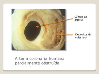Artéria coronária humana
parcialmente obstruída
Lúmen da
artéria
Depósitos de
colesterol
 