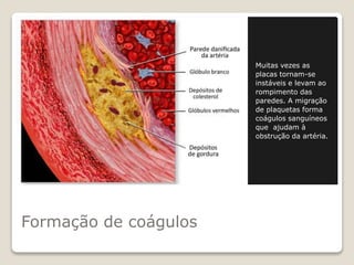 Formação de coágulos
Muitas vezes as
placas tornam-se
instáveis e levam ao
rompimento das
paredes. A migração
de plaquetas forma
coágulos sanguíneos
que ajudam à
obstrução da artéria.
 