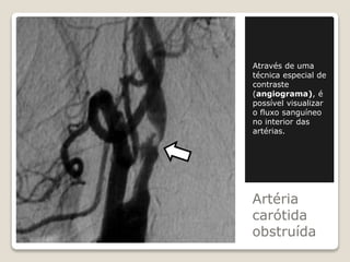 Artéria
carótida
obstruída
Através de uma
técnica especial de
contraste
(angiograma), é
possível visualizar
o fluxo sanguíneo
no interior das
artérias.
 
