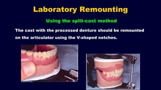 Laboratory Remounting
Using the split-cast method
The cast with the processed denture should be remounted
on the articulator using the V-shaped notches.
 