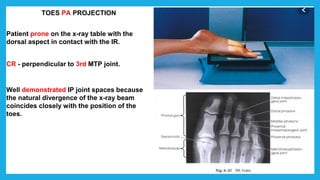 TOES PA PROJECTION
Patient prone on the x-ray table with the
dorsal aspect in contact with the IR.
CR - perpendicular to 3rd MTP joint.
Well demonstrated IP joint spaces because
the natural divergence of the x-ray beam
coincides closely with the position of the
toes.
 