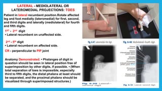 LATERAL - MEDIOLATERAL OR
LATEROMEDIAL PROJECTIONS: TOES
Patient in lateral recumbent position.Rotate affected
leg and foot medially (lateromedial) for first, second,
and third digits and laterally (mediolateral) for fourth
and fifth digits.
1ST - 2nd digit
• Lateral recumbent on unaffected side.
2nd - 5th digit
• Lateral recumbent on affected side.
CR - perpendicular to PIP joint
Anatomy Demonstrated: • Phalanges of digit in
question should be seen in lateral position free of
superimposition by other digits, if possible. • (When
total separation of toes is impossible, especially
third to fifth digits, the distal phalanx at least should
be separated, and the proximal phalanx should be
visualized through superimposed structures.)
 