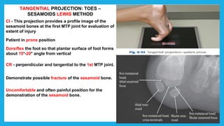 TANGENTIAL PROJECTION: TOES –
SESAMOIDS LEWIS METHOD
CI - This projection provides a profile image of the
sesamoid bones at the first MTP joint for evaluation of
extent of injury
Patient in prone position
Dorsiflex the foot so that plantar surface of foot forms
about 15°-20° angle from vertical
CR - perpendicular and tangential to the 1st MTP joint.
Demonstrate possible fracture of the sesamoid bone.
Uncomfortable and often painful position for the
demonstration of the sesamoid bone.
 