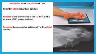 SESAMOID BONE CAUSTON METHOD
Patient in lateral recumbent position.
Directed to the prominence of the 1st MTP joint at
an angle of 40° toward the heel.
Sesamoid bone projected axiolaterally with a slight
overlap.
 