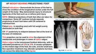 AP WEIGHT-BEARING PROJECTIONS: FOOT
Clinical Indications • Demonstrate the bones of the feet to
show the condition of the longitudinal arches under the full
weight of the body • May demonstrate injury to structural
ligaments of the foot such as a Lisfranc joint injury
NOTE: Bilateral projections of both feet often are taken for
comparison. Some AP routines include separate
projections of each foot taken with CR centered to
individual foot.
Patient pos,. in standing erect with full weight evenly
distributed on both feet
CR 15° posteriorly to midpoint between feet at the level of
the base of metatarsal.
This projection can be used to show the alignment of the
metatarsals and phalanges in cases of hallux valgus.
Hallux valgus is the commonest forefoot deformity, with an
estimated prevalence of 23% to 35%. It causes symptoms
on the medial edge of the foot, the sole, and the small toes.
Non-operative treatment may alleviate symptoms but does
not correct the deformity of the big toe
 