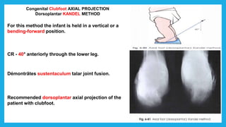 Congenital Clubfoot AXIAL PROJECTION
Dorsoplantar KANDEL METHOD
For this method the infant is held in a vertical or a
bending-forward position.
CR - 40° anteriorly through the lower leg.
Démontrâtes sustentaculum talar joint fusion.
Recommended dorsoplantar axial projection of the
patient with clubfoot.
 