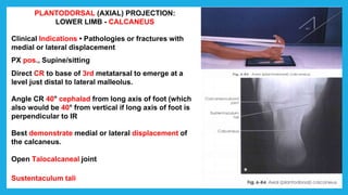 PLANTODORSAL (AXIAL) PROJECTION:
LOWER LIMB - CALCANEUS
Clinical Indications • Pathologies or fractures with
medial or lateral displacement
PX pos., Supine/sitting
Direct CR to base of 3rd metatarsal to emerge at a
level just distal to lateral malleolus.
Angle CR 40° cephalad from long axis of foot (which
also would be 40° from vertical if long axis of foot is
perpendicular to IR
Best demonstrate medial or lateral displacement of
the calcaneus.
Open Talocalcaneal joint
Sustentaculum tali
 
