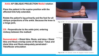 Ankle AP OBLIQUE PROJECTION Medial rotation
Place the patient in the supine position with the
affected limb fully extended.
Rotate the patient's leg primarily and the foot for all
oblique projections of the ankle. Because the knee is
a hinge joint,
CR - Perpendicular to the ankle joint, entering
midway between the malleoli
Demonstrated: • Distal tibia, fibula, and talus • Distal
tibia and fibula overlap some of the talus • Talus and
distal tibia and fibula adequately penetrated •
Tibiofibular articulation
 