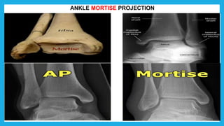 ANKLE MORTISE PROJECTION
 