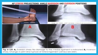 B
A
AP STRESS PROJECTIONS: ANKLE INVERSION AND EVERSION POSITIONS
 