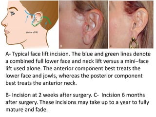 Facial Incision Lecture 3 facial cosmetic surgery | PPTX