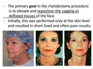 Lecture 3 facial cosmetic surgery PPT Lecture 3 facial cosmetic surgery PPT