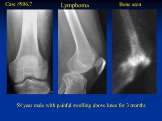 Case #906.7            Lymphoma                   Bone scan




    58 year male with painful swelling above knee for 3 months
 