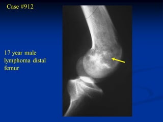 Case #912




17 year male
lymphoma distal
femur
 