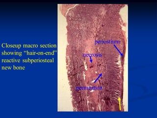 periostium
Closeup macro section
showing “hair-on-end”      necrosis
reactive subperiosteal
new bone


                         permeation
 