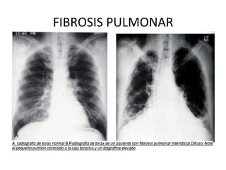 FIBROSIS
PULMONAR