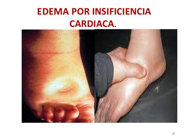 Resultado de imagen para Edema causado por insuficiencia cardÃaca