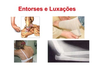 Entorses e Luxações
 