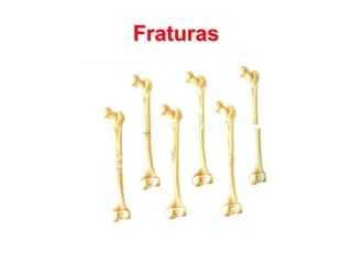 Fraturas
 