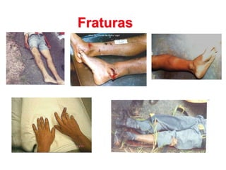 Fraturas
 
