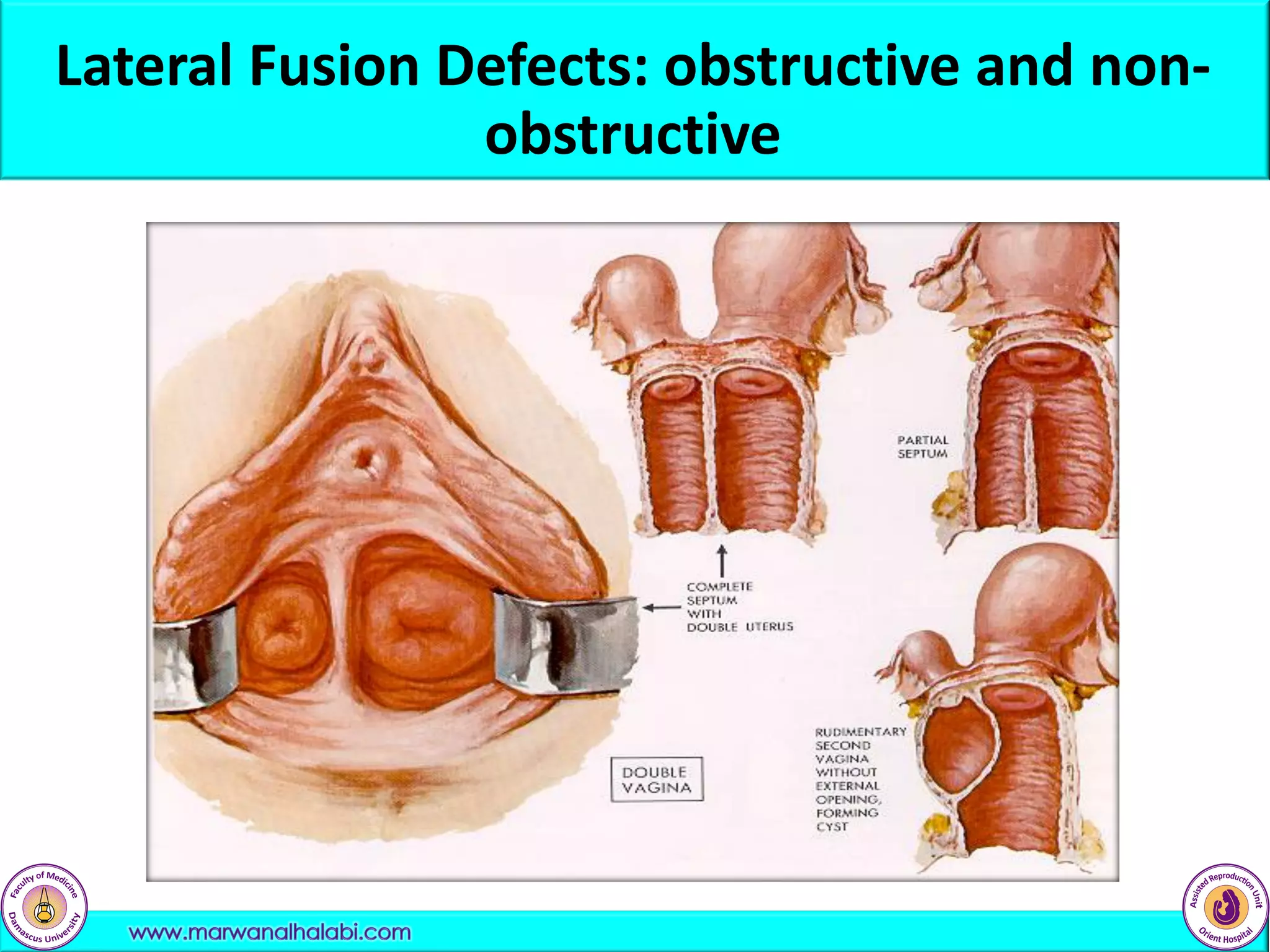 Lateral Fusion Defects: obstructive and non-
obstructive
 