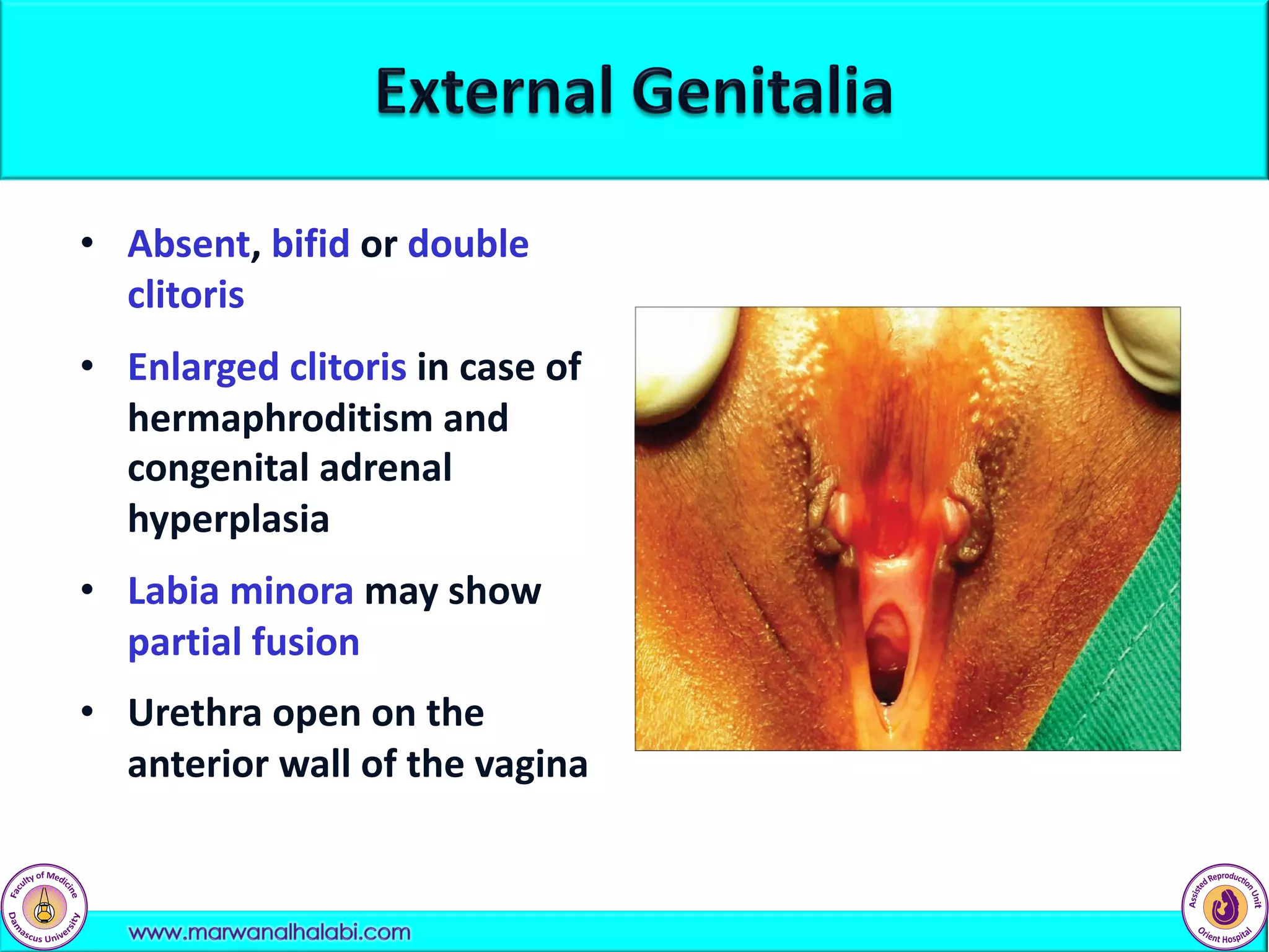 • Absent, bifid or double
clitoris
• Enlarged clitoris in case of
hermaphroditism and
congenital adrenal
hyperplasia
• Labia minora may show
partial fusion
• Urethra open on the
anterior wall of the vagina
 