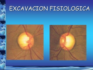 EXCAVACION FISIOLOGICA
 