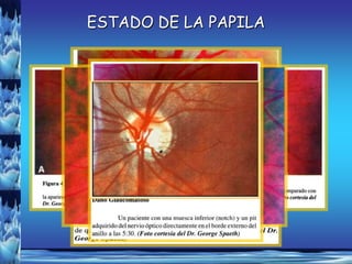 ESTADO DE LA PAPILA




     HEMORRAGIAS DEL DISCO
    PRESENCIA DE EXCAVACIÓN
    (FRECUENTE EN GLAUCOMA
  ASIMETRÍA DE LA EXCAVACIÓN
ATROFIA PERIPAPILAR (SEMILUNA
ANILLO NEURORETINIANO ADELGAZADO
        PAPILAR Y PALIDEZ
   PÁLIDA TENSIÓN NORMAL)
       DE EN ZONA TEMPORAL)
 