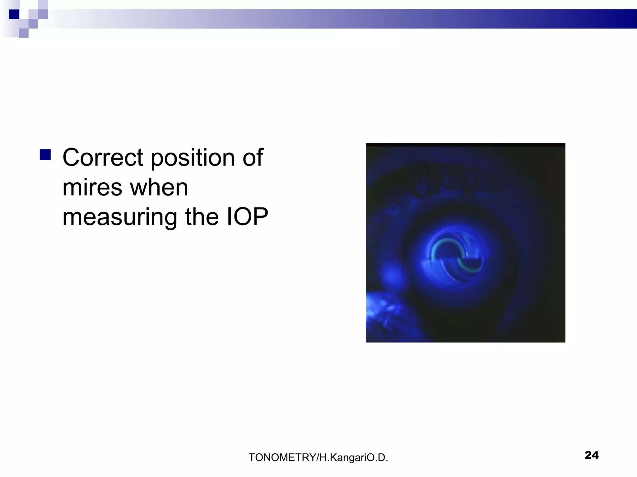 

Correct position of
mires when
measuring the IOP

TONOMETRY/H.KangariO.D.

24

 