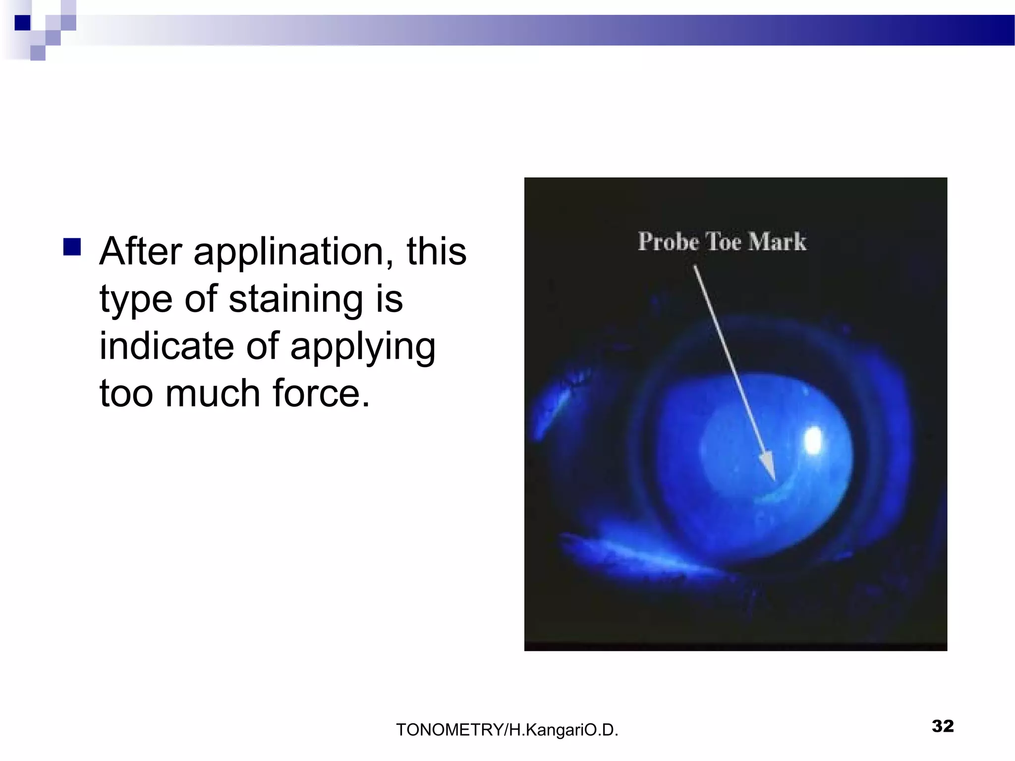 

After applination, this
type of staining is
indicate of applying
too much force.

TONOMETRY/H.KangariO.D.

32

 