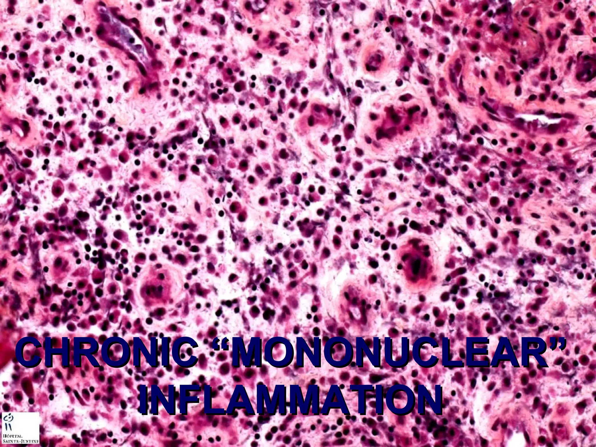 CCHHRROONNIICC ““MMOONNOONNUUCCLLEEAARR”” 
IINNFFLLAAMMMMAATTIIOONN 
 