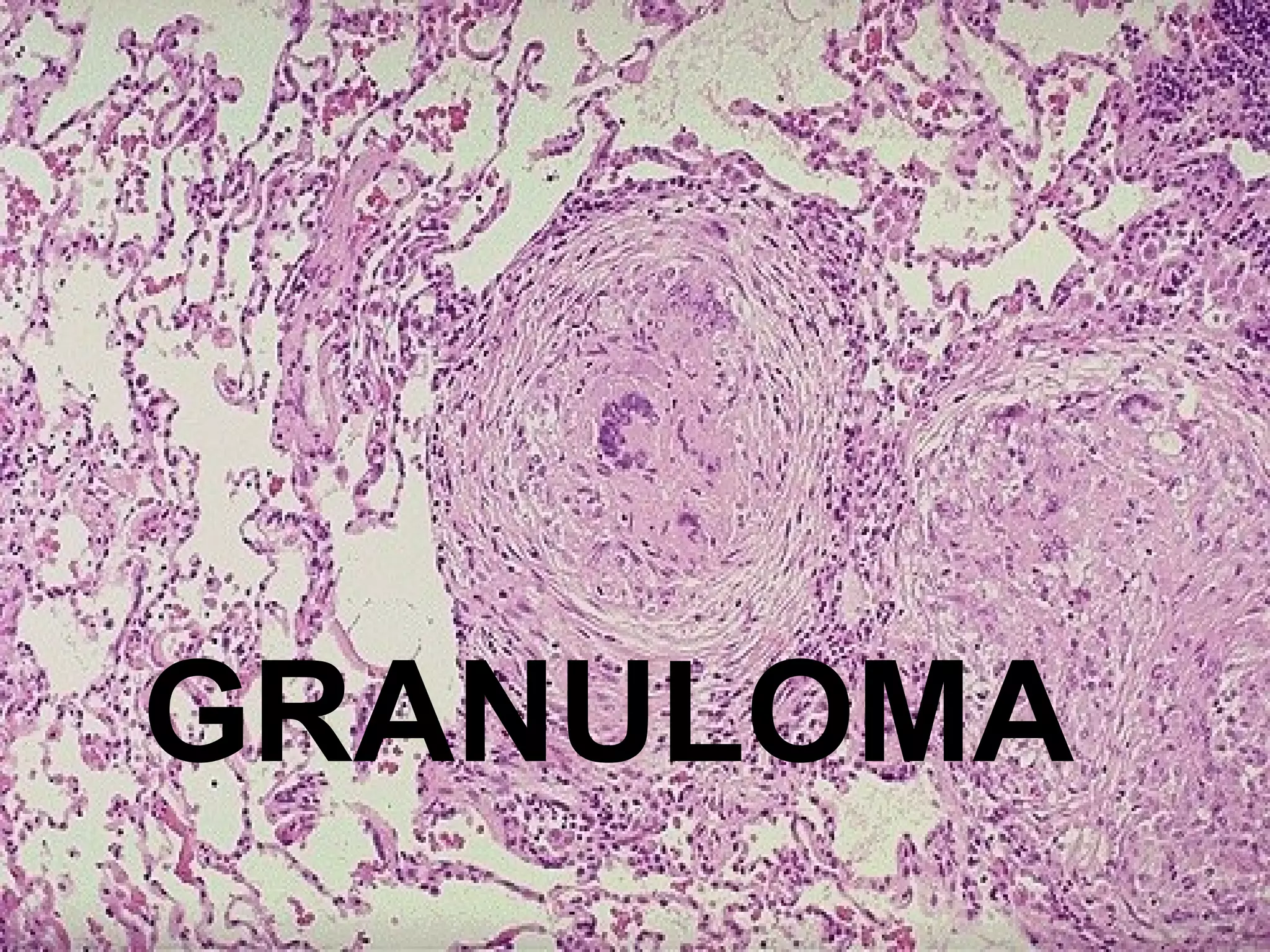 GRANULOMA 
 
