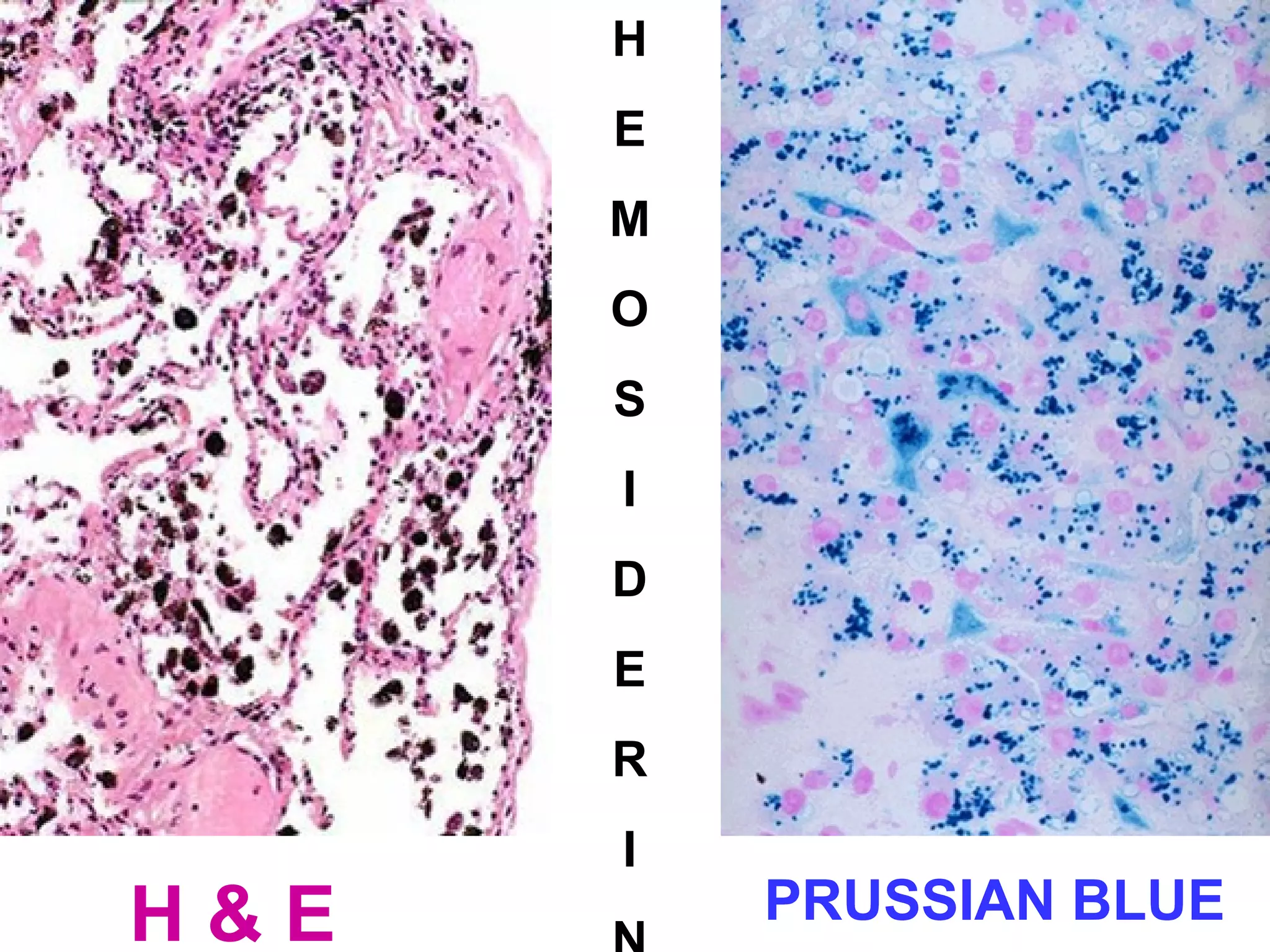 H 
E 
M 
O 
S 
I 
D 
E 
R 
I 
N 
H & E PRUSSIAN BLUE 
 