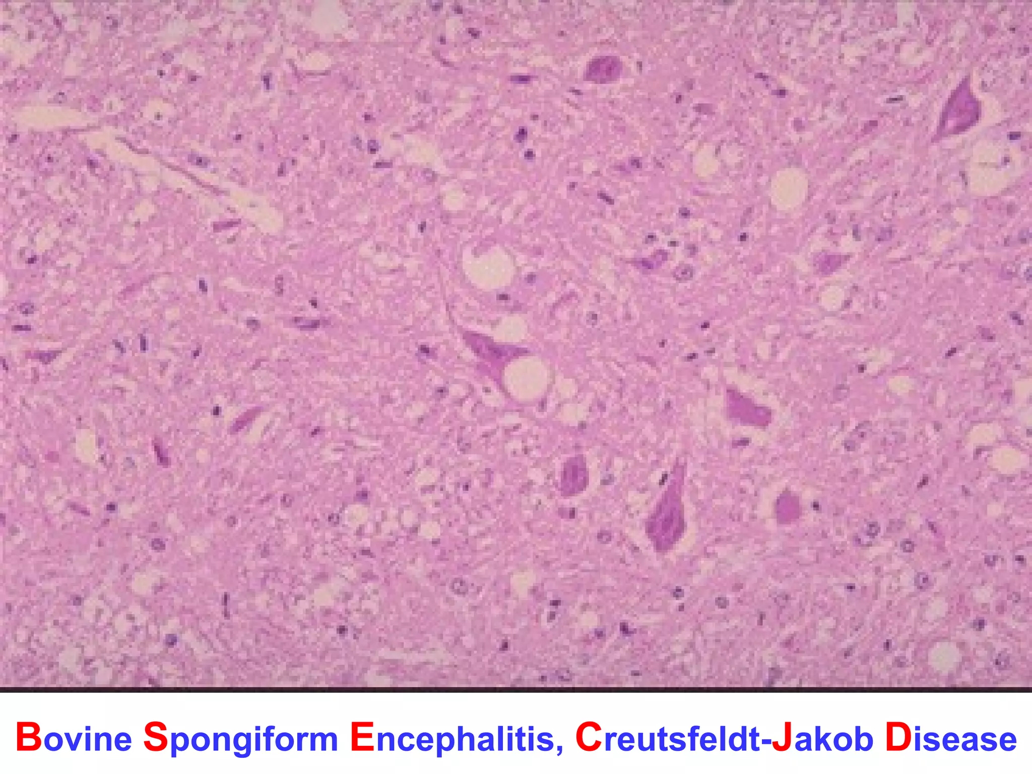 Bovine Spongiform Encephalitis, Creutsfeldt-Jakob Disease 
 