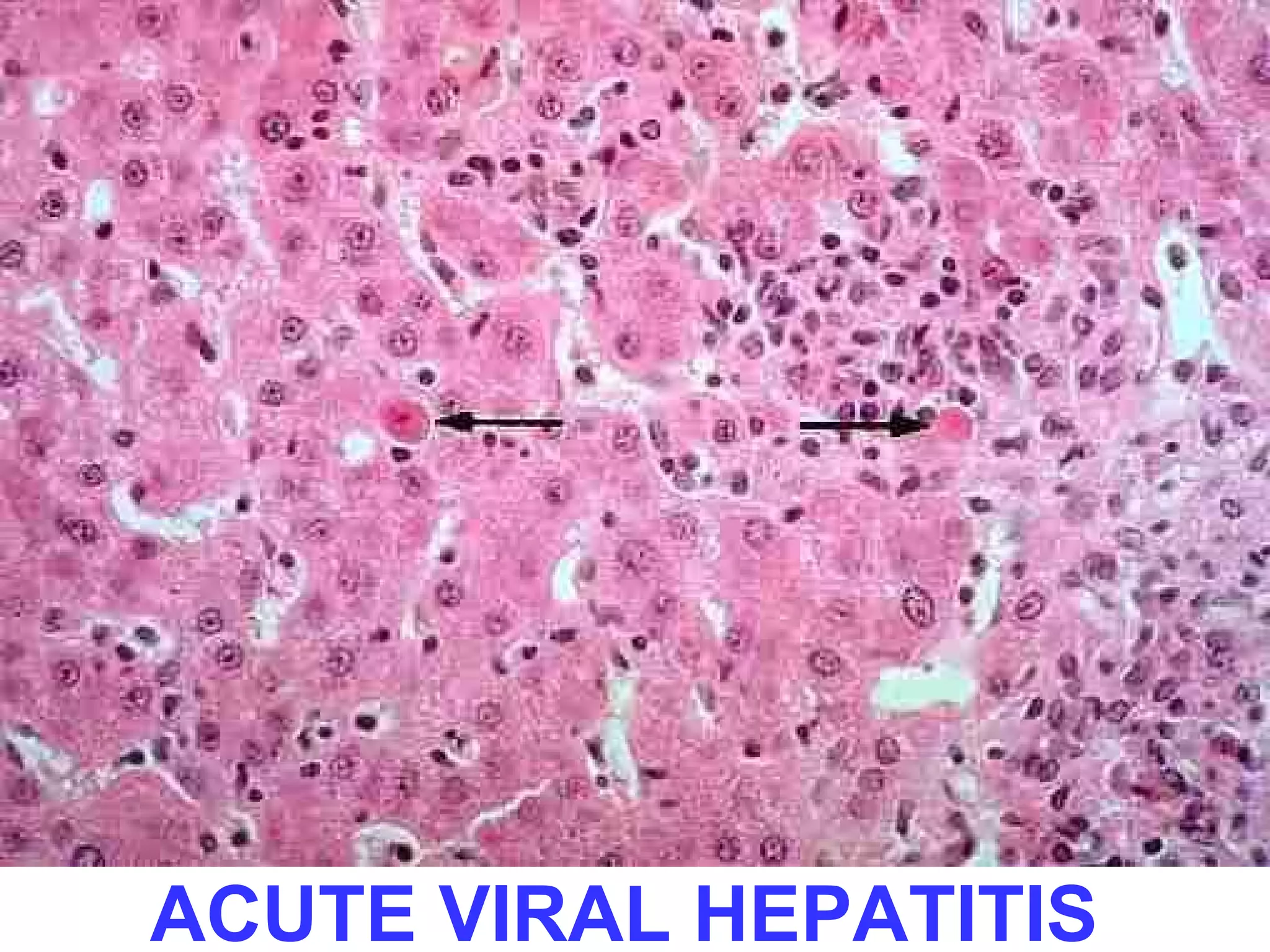 ACUTE VIRAL HEPATITIS 
 