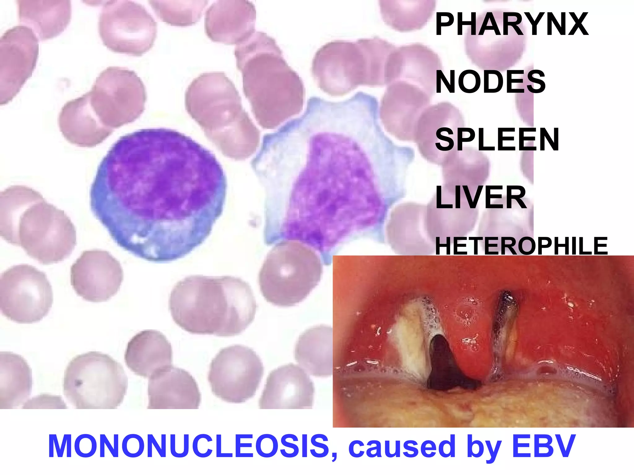 PHARYNX 
NODES 
SPLEEN 
LIVER 
HETEROPHILE 
MONONUCLEOSIS, caused by EBV 
 