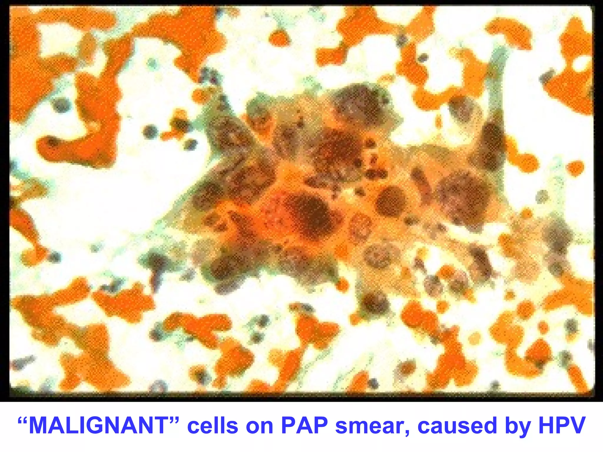 “MALIGNANT” cells on PAP smear, caused by HPV 
 